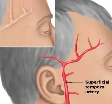 Почему сильно болит голова в правом виске