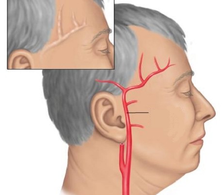 болит голова в левой височной части с глазом