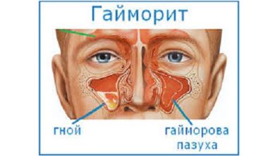 С чем связана температура и болит спина